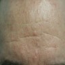 Multiple sebaceous hyperplasia on forehead