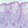 Pathology Outlines - Spitz nevus