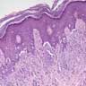 Pathology Outlines - Spitz nevus