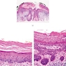 Pathology Outlines - Actinic keratosis