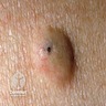 Epidermoid cyst with central punctum