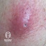 Inflamed epidermoid cyst