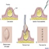 Resection of epidermoid cyst