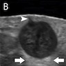 Hypoechoic lesion with connecting punctum