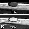 Epidermoid cyst MRI