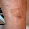 Sharply demarcated brown macule on the arm