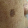 Sharply demarcated brown macule on the cheek