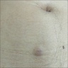 Firm nodule on abdomen