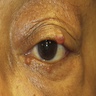 Pink-red nodules on eyelids