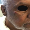 Skin colored nodule on cheek