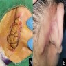 Posterior auricular skin lesion