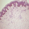 Pathology Outlines - Syringoma