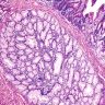 Pathology Outlines - Brunner gland nodule