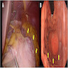 Gastric fundus tumor