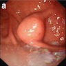 Gastric body tumor