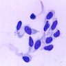 Spindle shaped to ovoid neoplastic cells