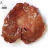 AH presenting as a solid mass with a central scar