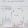 Frameshift mutation (deletion) of <i>APC</i> at exon15