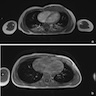 Chest wall tumor (MRI)