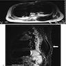 Paravertebral mass (MRI)