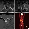 Intraosseous hibernoma (MRI, CT and PET)