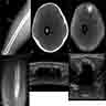 Radiology of different stages