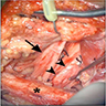 Preoperative photo of enlarged brachial plexus