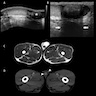 Ultrasonographic, T2 weighted MR and CT scan images