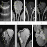 Scrotal ultrasound and MR images