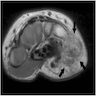 Poorly defined, infiltrative tumor