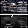 Hypoechoic nodule on ultrasound