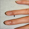 Firm nodule on finger