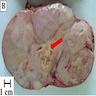 Circumscribed lobulated mass