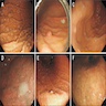 PPI related gastric mucosal changes