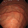 Black spots in the gastric mucosa