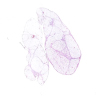 Lipoma-like well differentiated liposarcoma