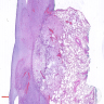 Dedifferentiated liposarcoma