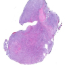 Myxoid liposarcoma