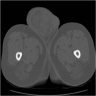 WDLPS CT pelvis