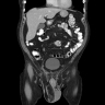 DDLPS CT abdomen / pelvis