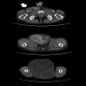 DDLPS CT abdomen / pelvis