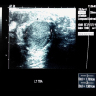 DDLPS scrotal ultrasound