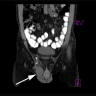 DDLPS CT abdomen / pelvis