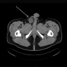 DDLPS CT abdomen / pelvis