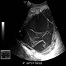 DDLPS scrotal ultrasound