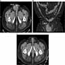 DDLPS CT abdomen / pelvis