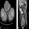 DDLPS CT abdomen / pelvis