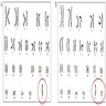 Karyotype, mosaic of 45,X / 46,XY