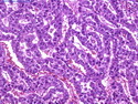 Pathology Outlines - Embryonal carcinoma