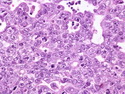 Pathology Outlines - Embryonal carcinoma